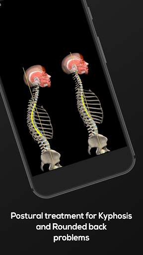 Kyphosis & Rounded Back by M&M ekran görüntüsü
